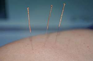 Akupunktur gegen Falten